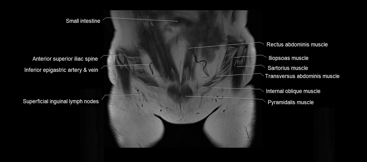 MRI 3T pelvis coronal cross section anatomy image 2.webp